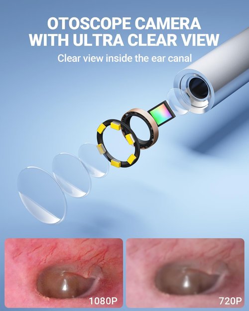 ScopeAround Otoscope - 4.5" IPS Screen Ear Camera with Gyroscope & Light | 32GB Card Included