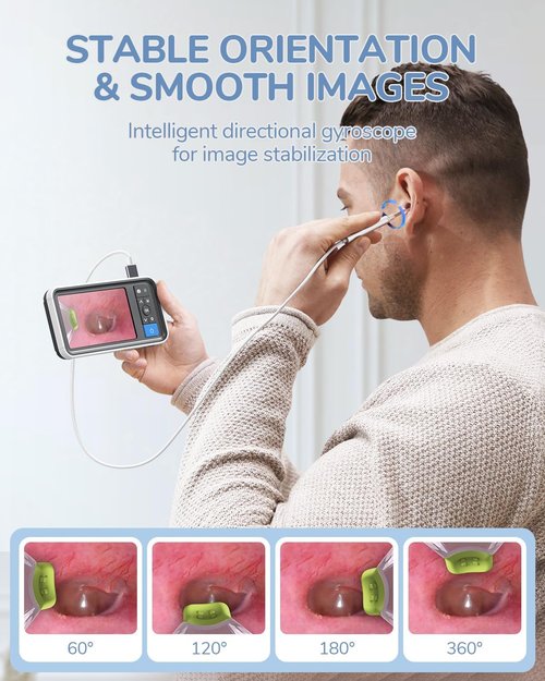 ScopeAround Otoscope - 4.5" IPS Screen Ear Camera with Gyroscope & Light | 32GB Card Included